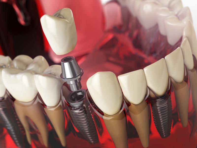 Imagen de cómo se hace un implante dental