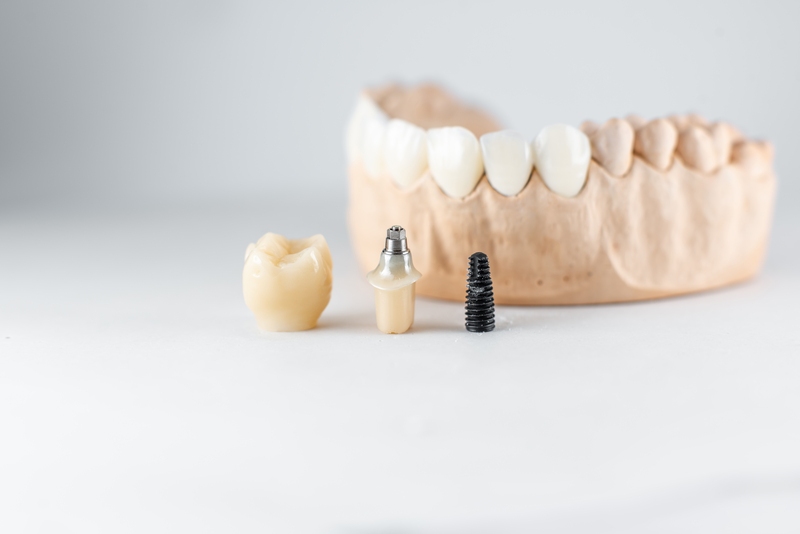 dentadura e imagen de tornillos y pieza dental, representando un implante dental